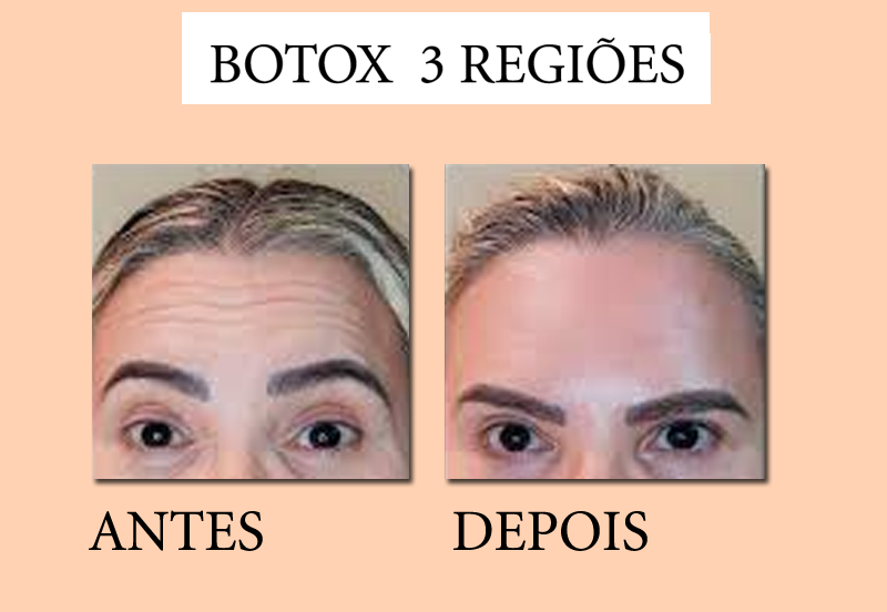 Botox Premium - Três Regiões ( Testa, glabela e periorbicular (pés de galinha)) - Imagem 2