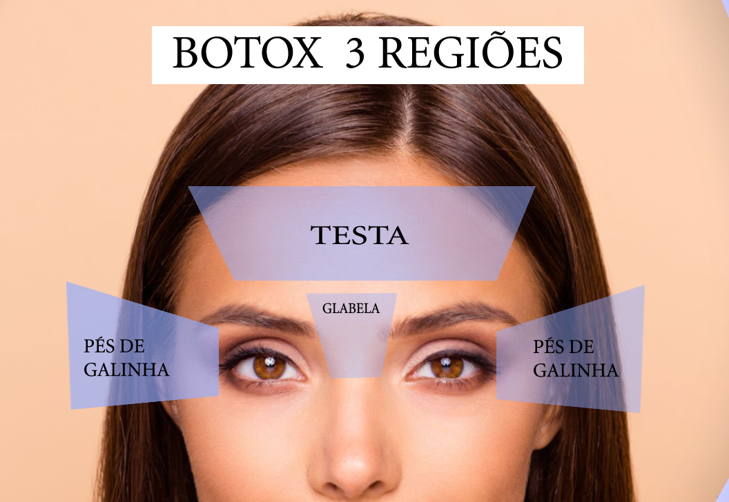 Botox Premium - Três Regiões ( Testa, glabela e periorbicular (pés de galinha)) - Imagem 4