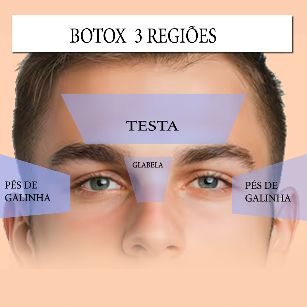 Botox Premium - Três Regiões ( Testa, glabela e periorbicular (pés de galinha))