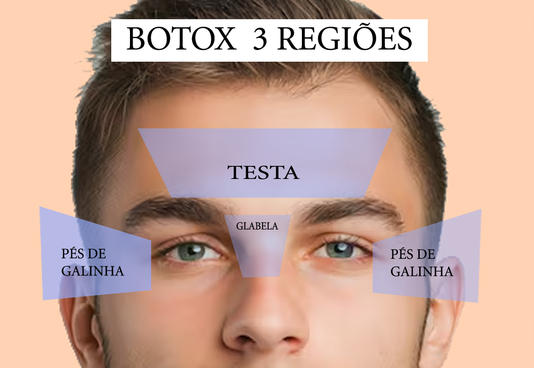 Botox Premium - Três Regiões ( Testa, glabela e periorbicular (pés de galinha)) - Imagem 3