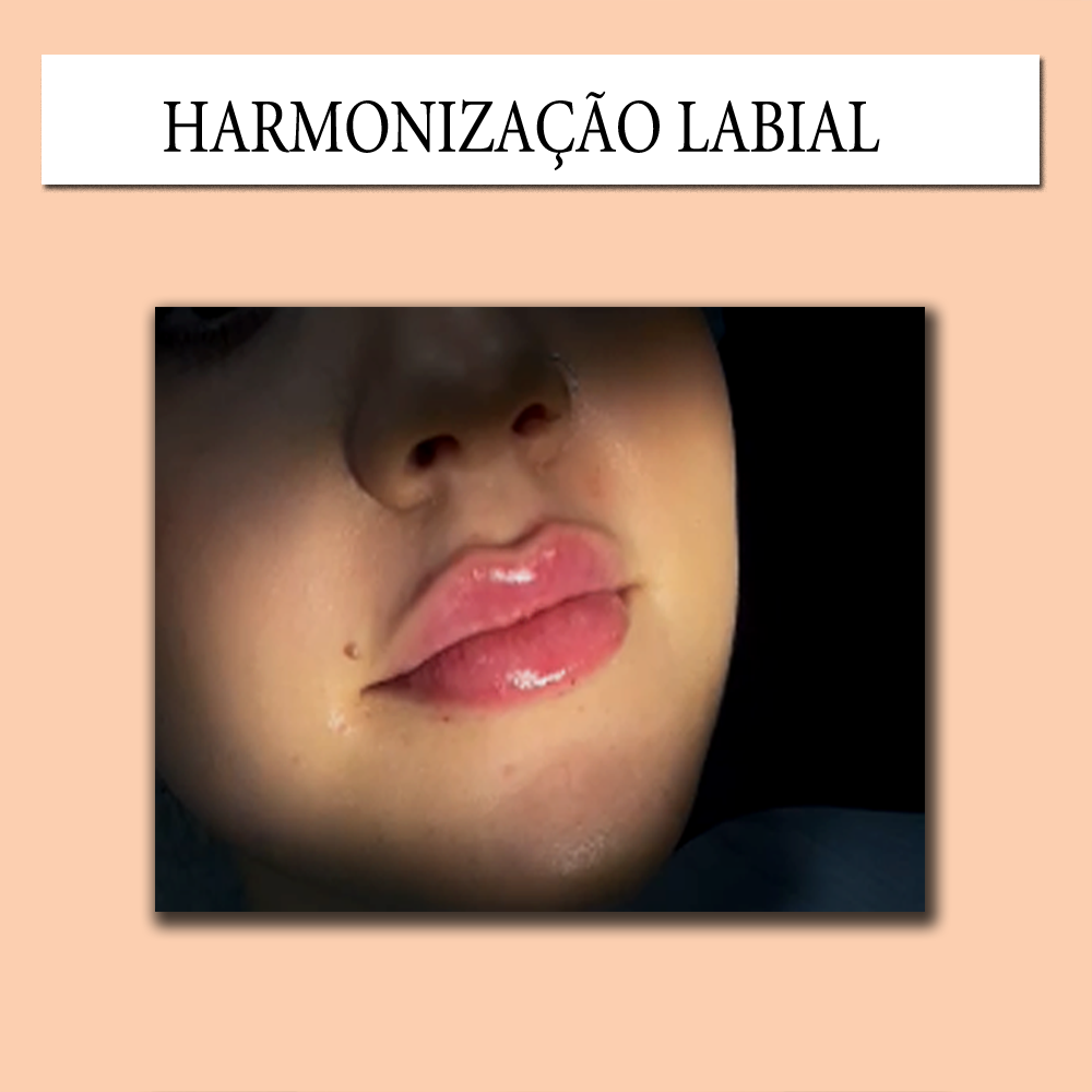 Harmonização Labial - Imagem 2