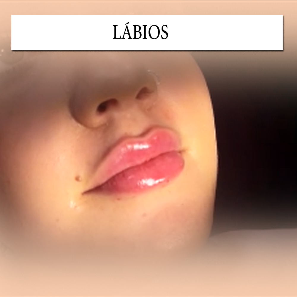 Harmonização Labial