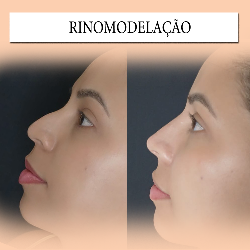 RINOMODELAÇÃO